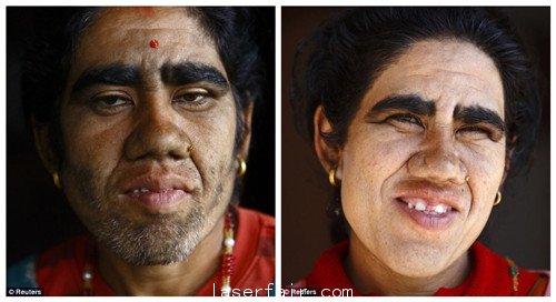 布德哈索基接受欧陆娱乐治疗前后的照片对比。 点击进入下一页